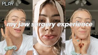 UNDERBITE JAW SURGERY | vlog + recovery days 1-14 | before & after