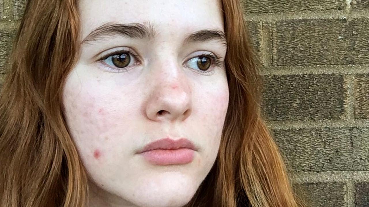 Relapsing After Accutane YouTube