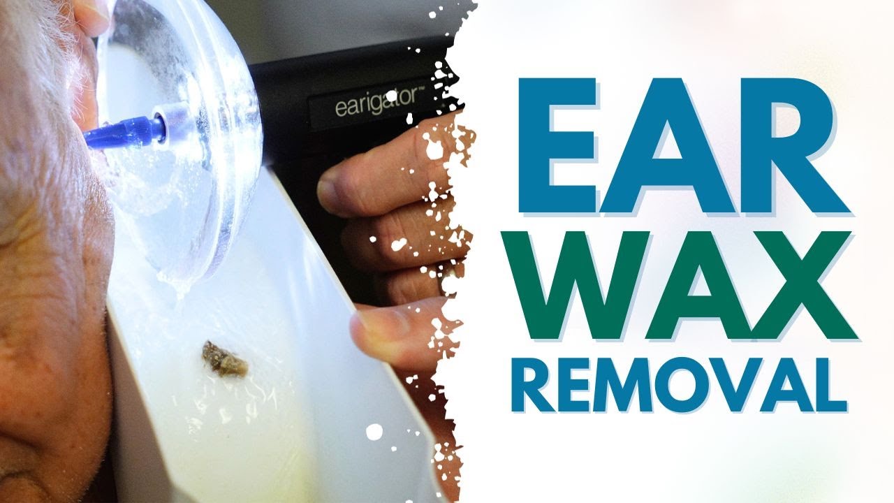 IMPRESSIVE piece of EARWAX removed during ear cleaning treatment in Florida YouTube