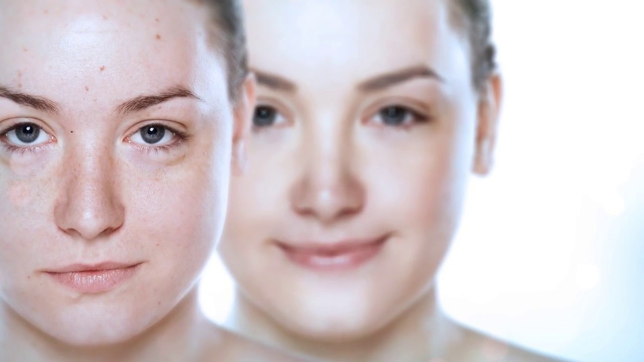 Solvaderm's Zeroblem - Acne Fighting Spot Treatment