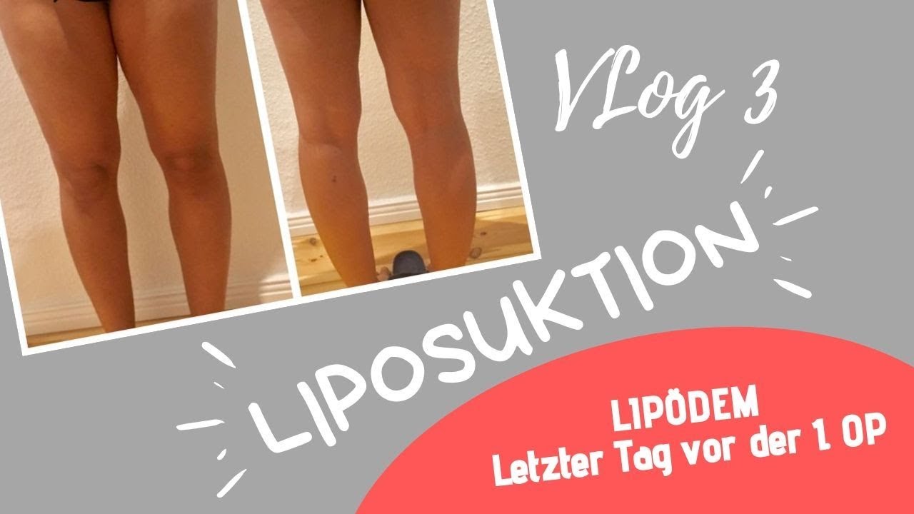 vlog-3-lip-dem-liposuktion-letzter-tag-vor-der-1-op-youtube