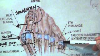 How Do You Fix a Bunionette? (Tailor's Bunion) | Dr. Moore Explains