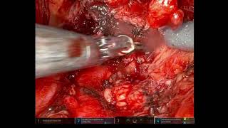 Robotic Assisted Resection of Left Renal Vein Sarcoma with Reconstruction with Bovine Pericardium