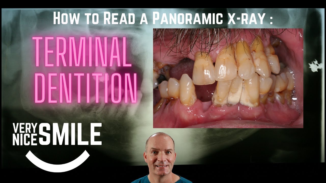 How to read a panoramic xray Terminal Dentition YouTube