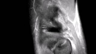 Posterolateral Corner Injury Of Knee.