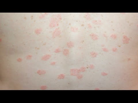 Video: Rozā ķērpis (Gibert) Cilvēkiem - Simptomi Un ārstēšana