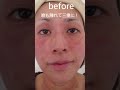 【アトピー】42歳肌荒れから美肌になれた理由