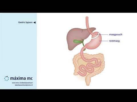 Video: Wat is 'n maagomleiding?