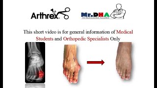 Metatarsal Distal Chevron with arthrex LPS Screw