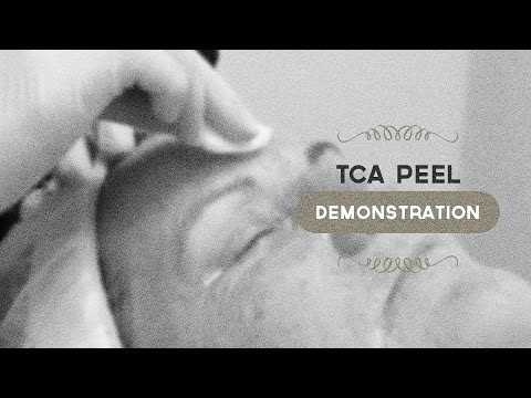 TCA peel