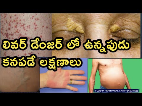Symptoms of Liver Disease in Telugu ( కాలేయ వ్యాధి లక్షణాలు)
