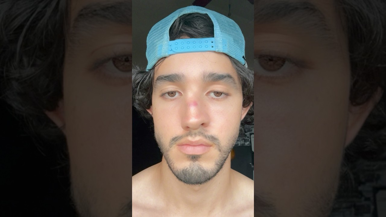 ME ROMPIERON LA NARIZ😭