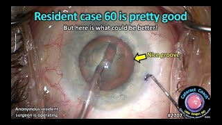 Cataractcoach 2707 Resident Cataract Surgery Case 60 Is Pretty Good