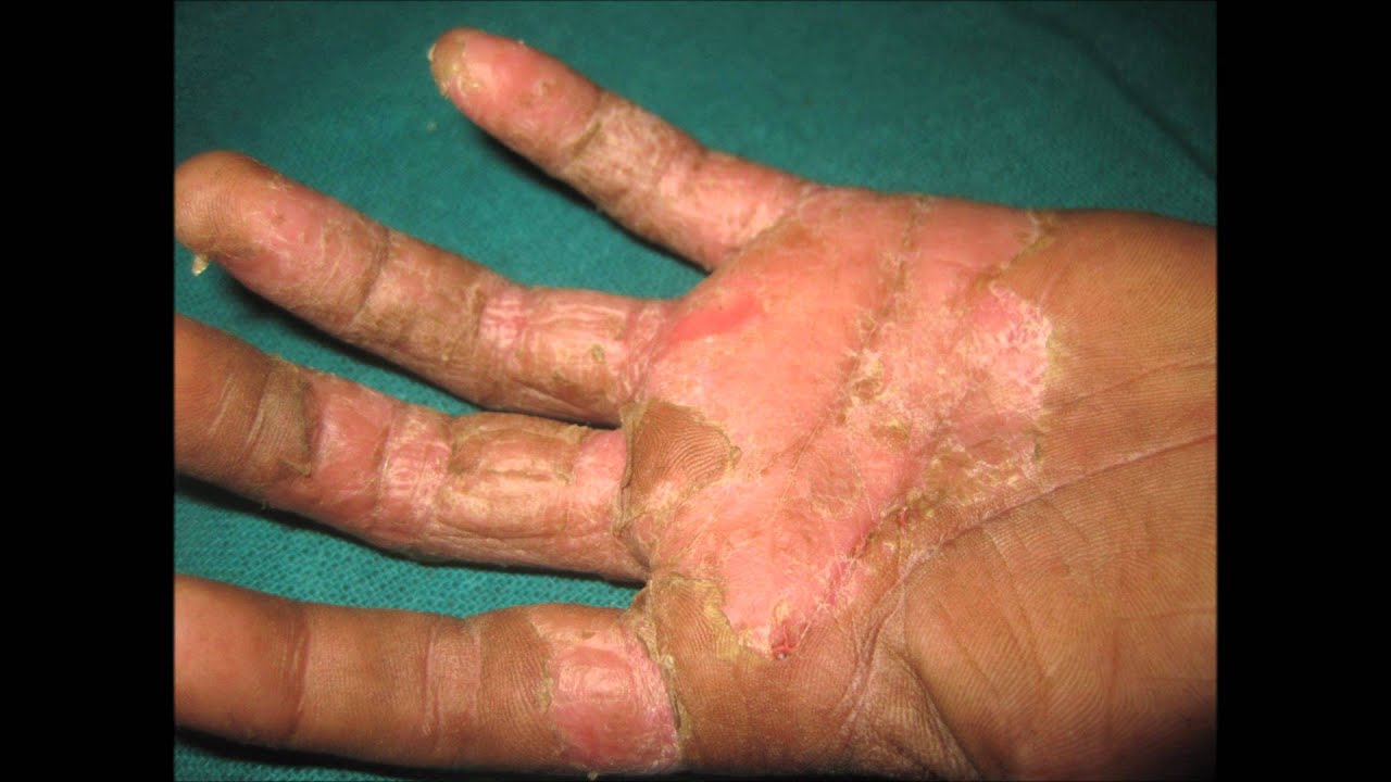 palm eczema #11