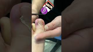 علاج الظفر الغائر |ظافر القدم الغارز في اللحمingrown toenail treatment