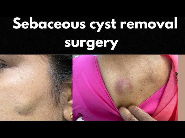 Seabaceous cyst removal surgery is simple before it gets infected || Dr. S. K. Gulati