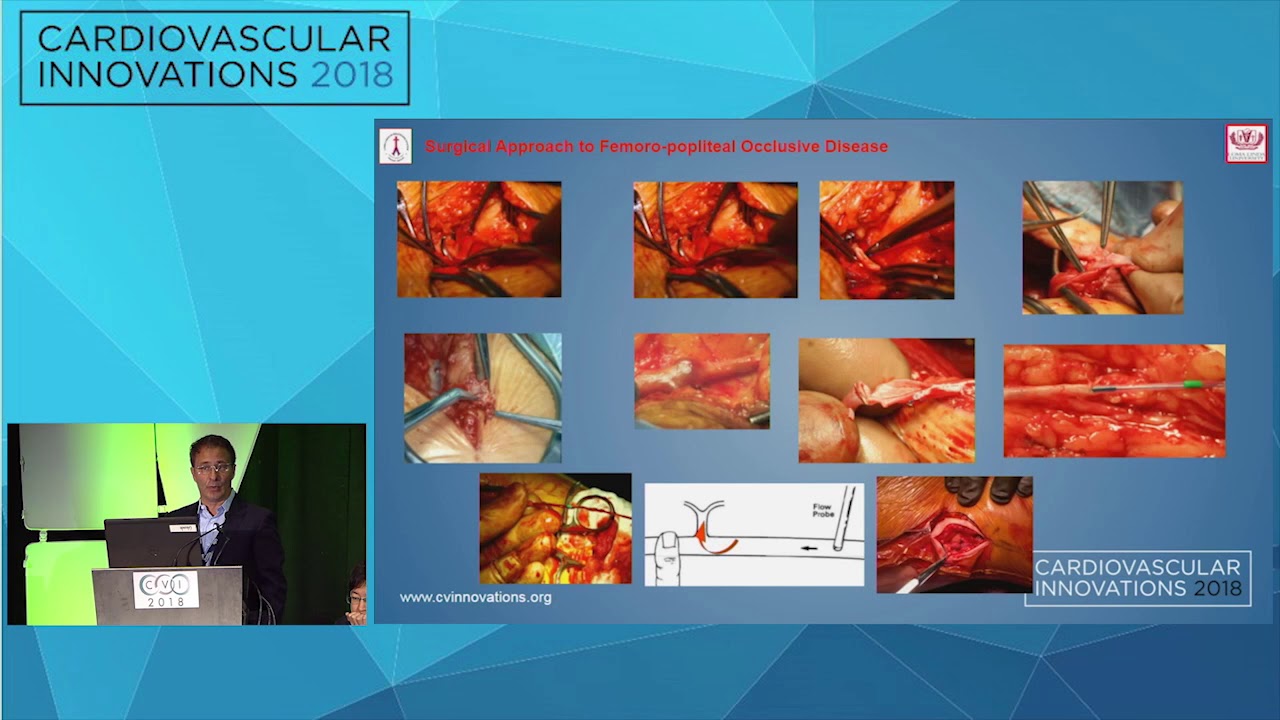 CVI2018 Session: Surgical approach to CFA, SFA and popliteal disease - Christian Bianchi, MD interventional cardiology jobs