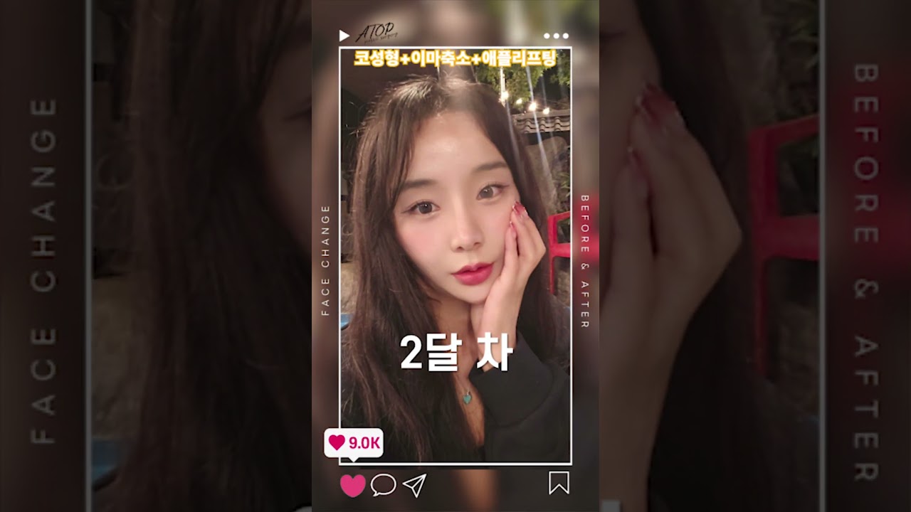 [Эйтоп гоо сайхны эмнэлэг] Хамрын гоо сайхны мэс засал + Духны багасгах мэс засал + Хацрын алим өргөх үзүүлэлт