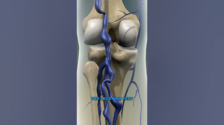 What causes varicose veins? (3D Animation)