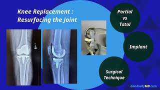 What is knee replacement?  The surgery and components used in partial and total knee replacement.