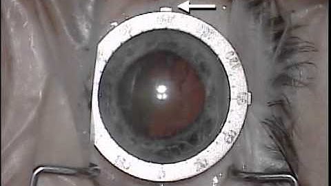 Dr. John Graether - Toric System - AE-2798N & AE-1594N - ASICO LLC