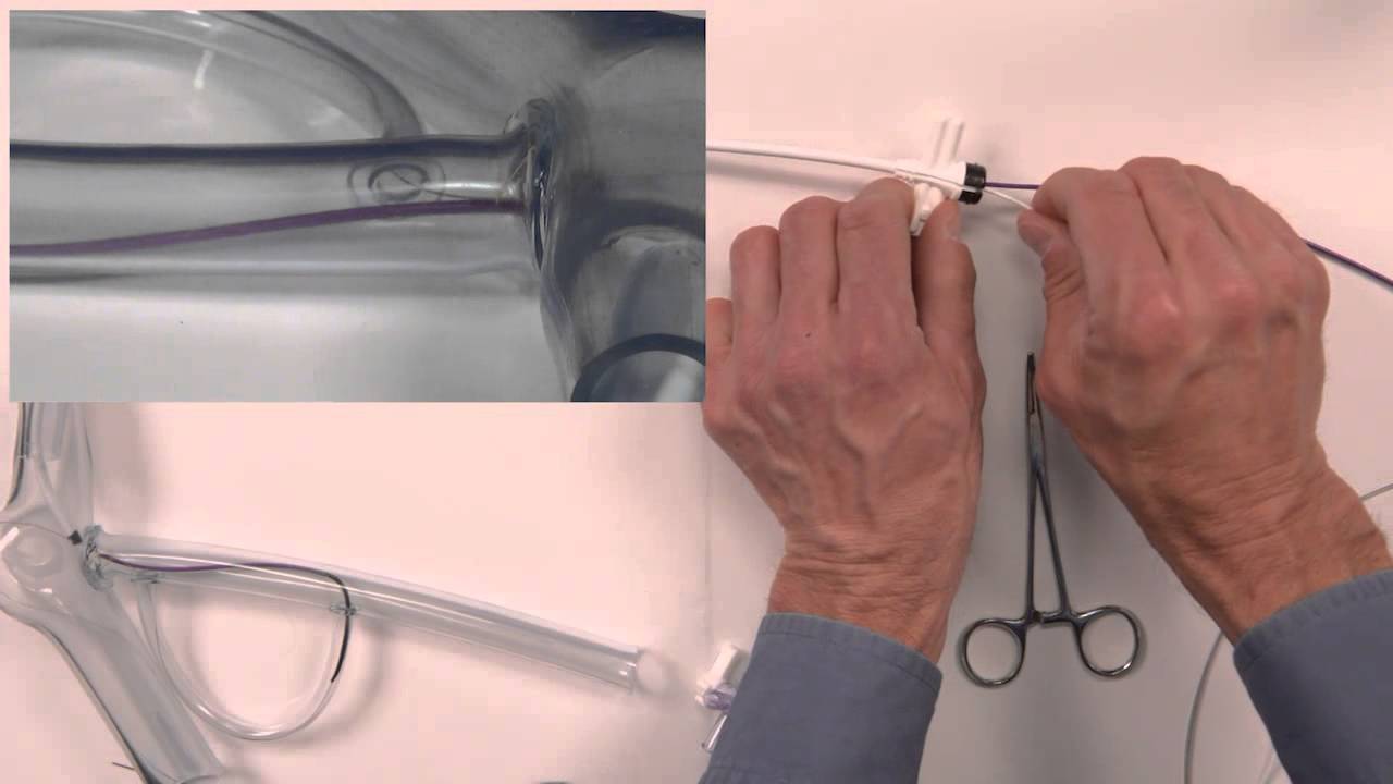 The Worley™ Snare Technique Difficult Vessel Anatomy to