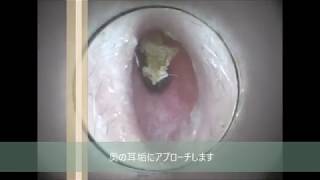 奥の耳垢が…実は大きかったんです！【イヤーエステ練習動画】No.64 1_earwax removal,earwax specialist,귀청소가게 내시경