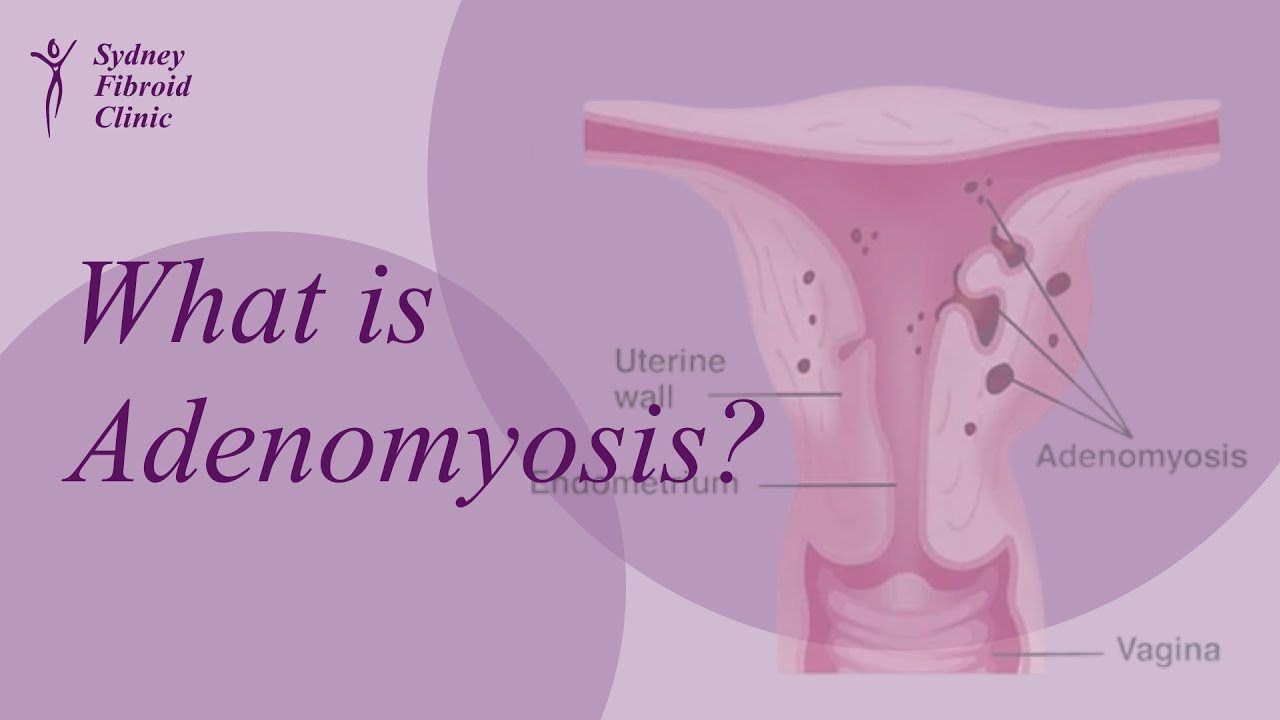Adenomyosis Explained: Symptoms, Causes and Treatment Options Including UAE