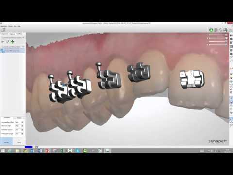 How to create a bracket transfer media in Appliance Designer