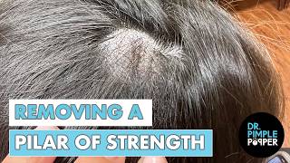 Removing A Pilar Of Strength Dr. Pimple Popper Removes A Pilar Cyst
