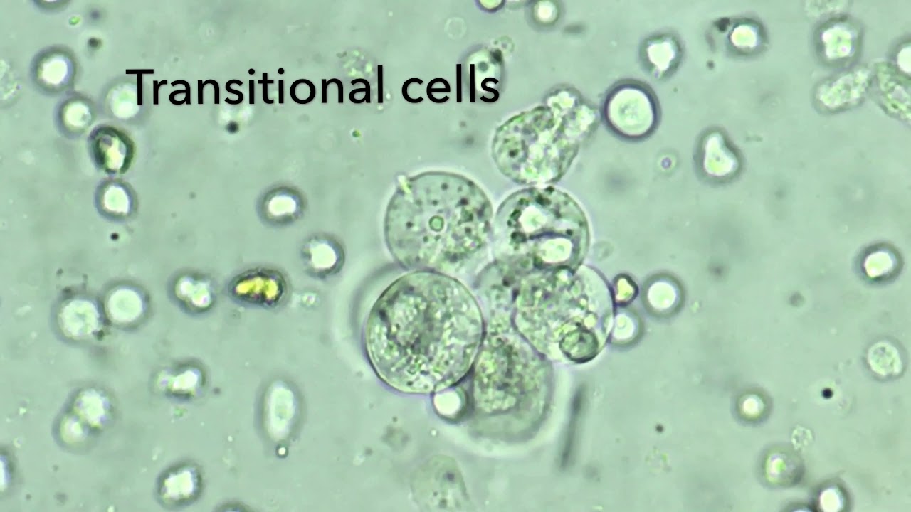 Transitional epithelial cells in urine - YouTube