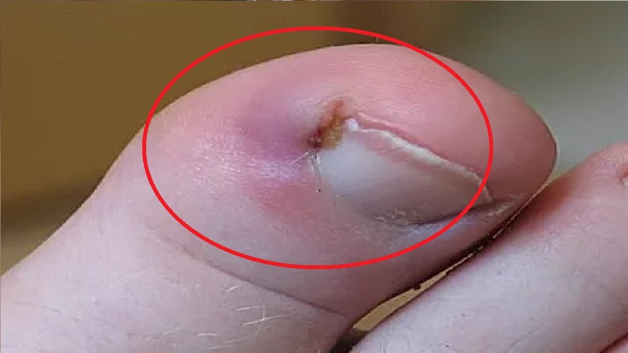 how to treat ingrown toenail with cotton wool fast and easy YouTube