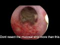 TURP Made Easy For Residents TURP Made Easy For Residents