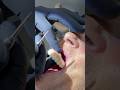 Removing the patient’s existing temporary to scan it with Shining 3D
