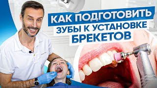 Подготовка зубов к установке брекетов у реального пациента клиники OrthoLike