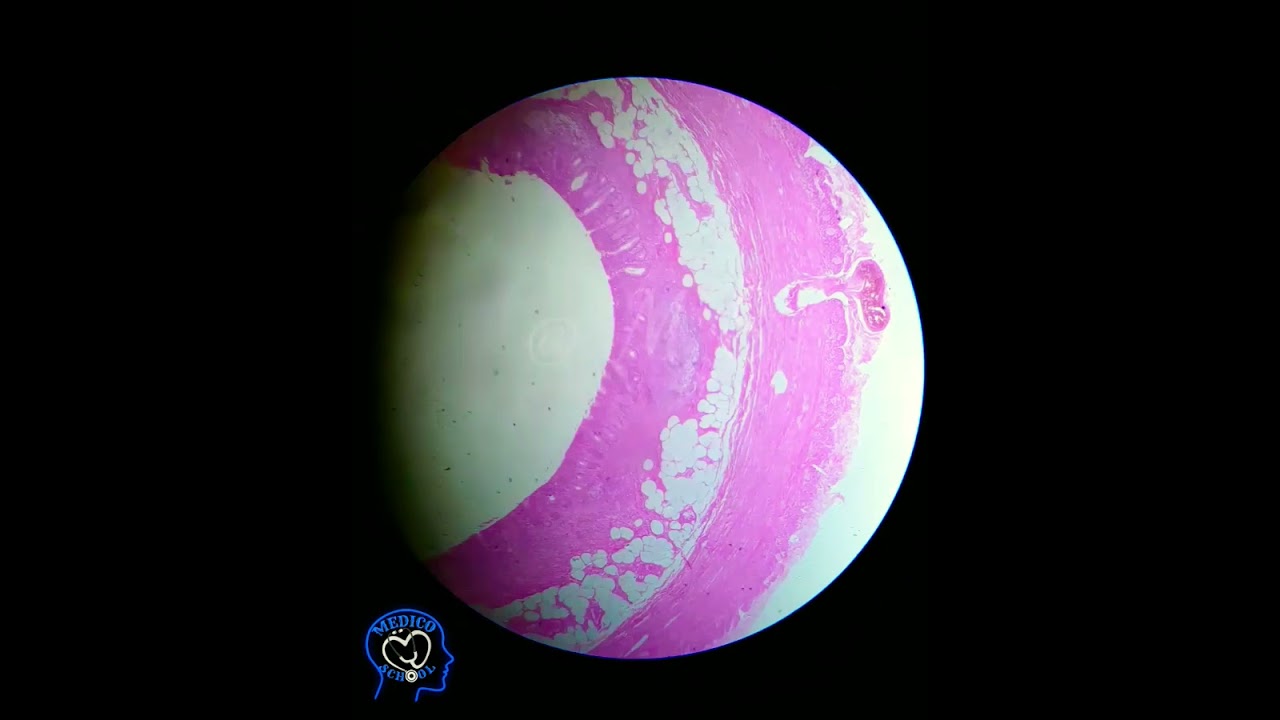 HUMAN Appendix pathology slides 