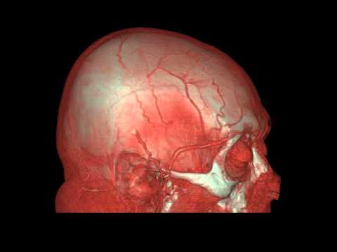 Video: Nenormalan Prolaz Između Arterija I Vena U Pasa