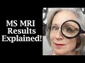 MS MRI Results Lesions and Atrophy Explained