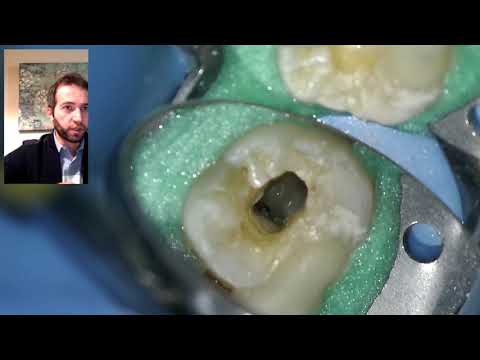 Video: Je zub číslo 31 molární?