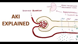 Acute Kidney Injury Explained