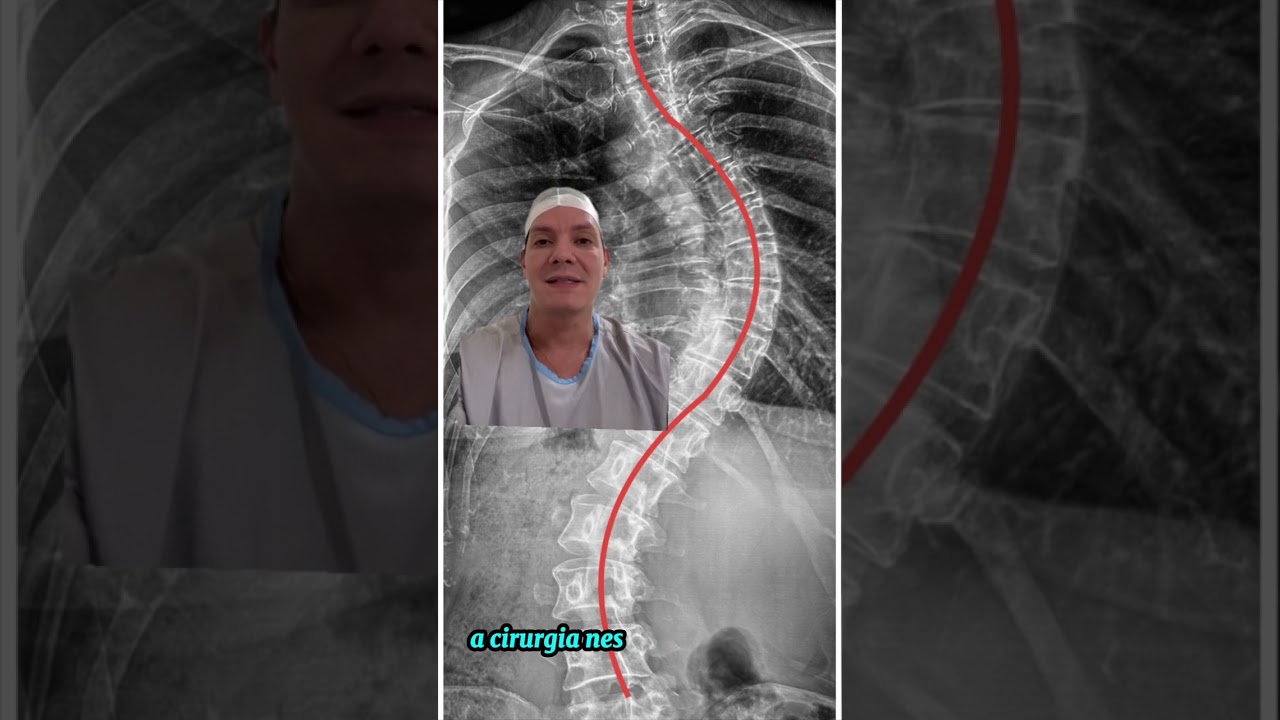 Operei essa amiga querida que tinha uma Escoliose bastante acentuada desde a adolescência