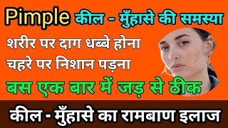 Keel Muhase Ka Gharelu ilaj | Pimple Ko Hatane Ka Tarika | Pimple Ko Hatane Ka Upay | Ayurveda 2M