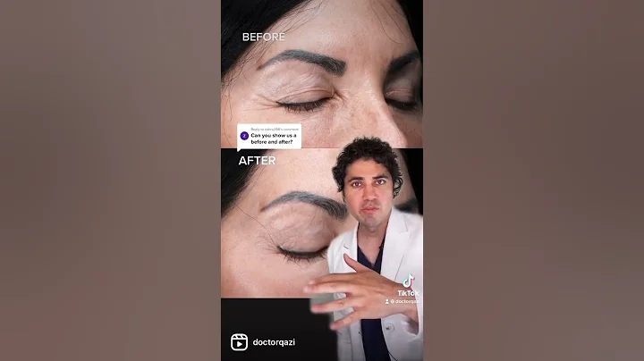 Take a Look at These Results for Laser Resurfacing Around the Eyes!