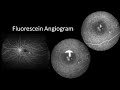 Navilas® - Targeting CSCR with Navigated Laser