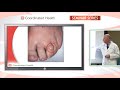 Bunions and Hammertoes On Demand Seminar