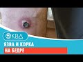 🦵 Язва и корка на бедре. Клинический случай №935