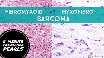 FIBROmyxo vs MYXOfibro Sarcoma Made Simple: 5-Minute Pathology Pearls