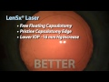 Alcon LenSx® Laser Cataract Surgery