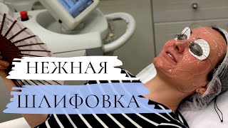 ЛАЗЕР для ШЛИФОВКИ лица / Что нужно знать /  Как ВЫБРАТЬ? Halo laser