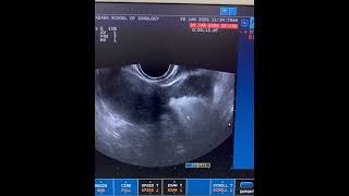 Subserosal fibroid